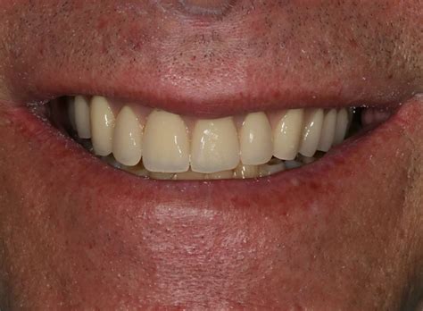 Case 8 Prosthodontics Graystone Referral Centre Referrals In Hassocks West Sussex