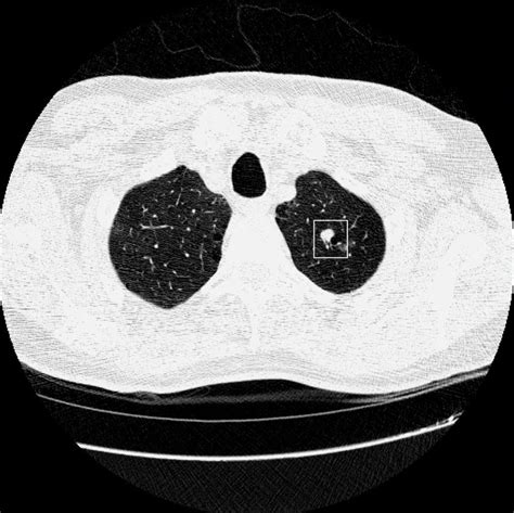 Lung Cancer Deaths Reduced By Ct Scans Study Finds The New York Times