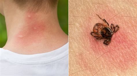What Does A Tick Look Like How To Recognize Tick Bites On Humans And