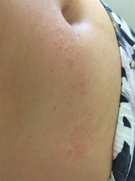 Is This Follicular Eczema Or Fungal Related Rdermatologyquestions