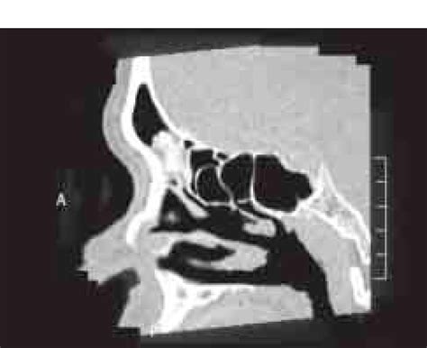 Sagittal View Of Reconstruction Ct Scan Showing Right Frontal Sinus