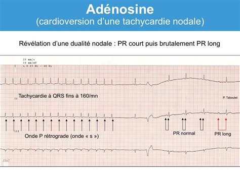 Adénosine Atp Indications E Cardiogram