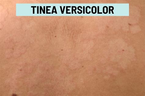 Pityriasis Alba Vs Tinea Versicolor Pictures And Differences