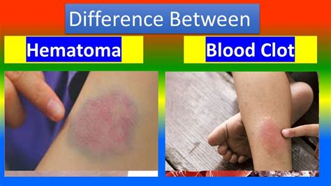 Contrast Between Hematoma And Blood Clot Youtube