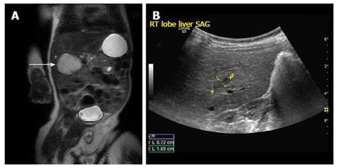History Of The Infantile Hepatic Hemangioma From Imaging To Generating