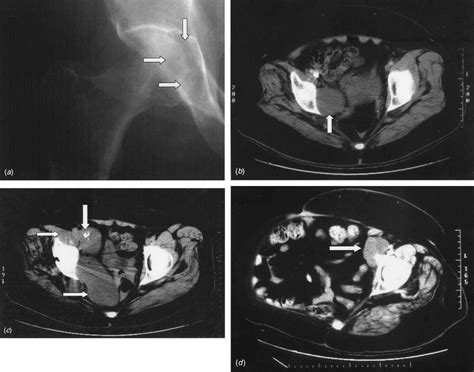 Sequential Imaging Of Our Case A Soft Tissue Mass In The Right Hip