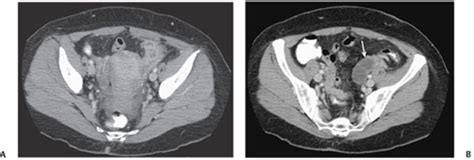 132 pelvic inflammatory disease with tubo ovarian abscess radiology key