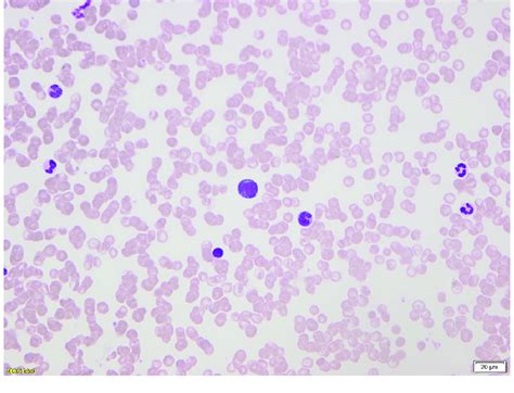 Peripheral Blood Smear Showing Circulating Lymphoma Cells