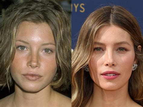 Plastic surgery procedures started as medical treatments but grew into cosmetic surgeries. Jessica Biel Plastic Surgery - With Before And After Photos