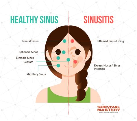 Sinus Infection Treatment Complete List Of Best Remedies