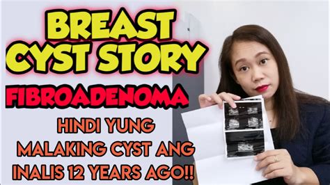 Breast Cyst Story Fibroadenoma Hindi Yung Malaking Cyst Ang Inalis
