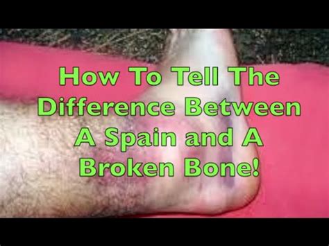 How likely is it to be broken and how urgently do i need to go to hospital? How To Tell The Difference Between A Sprain and A Break ...