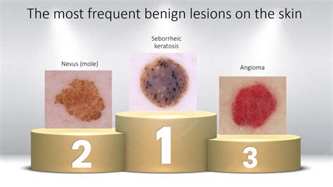 Benign Skin Lesions Dr Bela Clinic London
