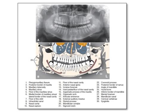 Normal Anatomic Landmarks On Panoramic Radiograph Dental Care
