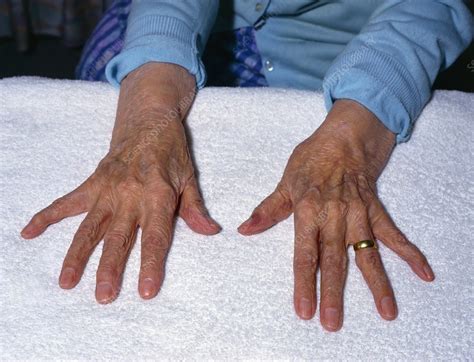 Elderly Ladies Arthritic Hands Spread Out Stock Image M1100325