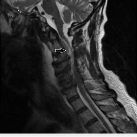 T2 Weighted Cervical Spine Mri In The Sagittal Plane Showing An