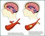 What Are The Side Effects Of Brain Surgery Images