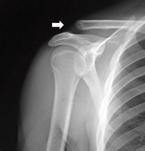 Radiografía anteroposterior AP de hombro Luxación acromioclavicular Download Scientific
