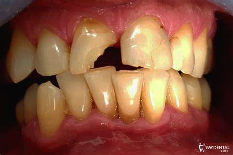 Frattura dentale coronale | I casi clinici di Wedental Care
