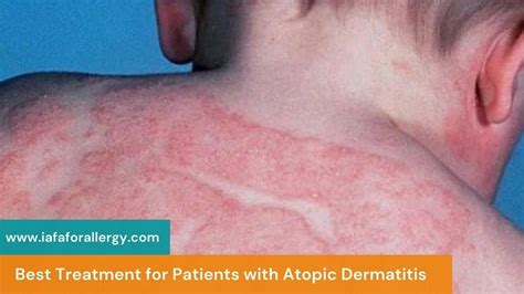 What Is The Best Treatment For Patients With Atopic Dermatitis