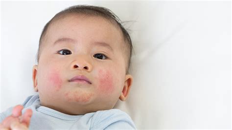 Baby Hives Symptoms Causes And Remedies For Hives On Baby