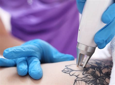 Tattoo Removal – Liberty Laser Clinic