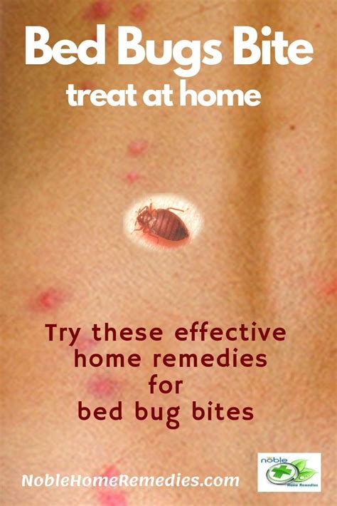How To Treat Flea And Bed Bug Bites