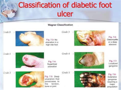 Diabetic foot ulcers are very common lower extremity wounds that occur in diabetics with peripheral neuropathy and are responsible for 85% of lower extremity amputations. Struggling HO: Diabetic Foot Ulcer