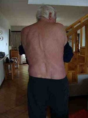 So what is low back strain? lower back pain and muscle spasm after lifting