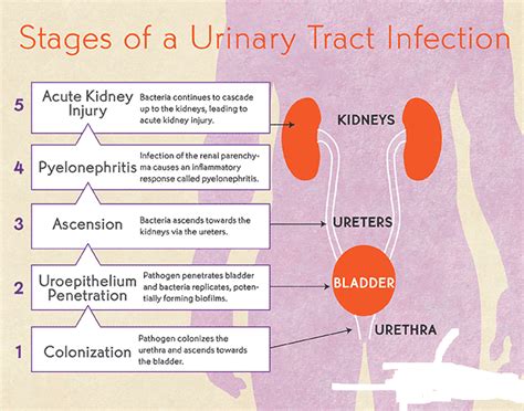Urinary Tract Infections Causes And Prevention Urinary Tract