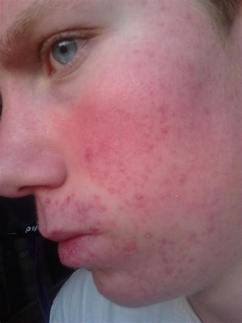 Accutane And Red Face Prescription Acne Medications