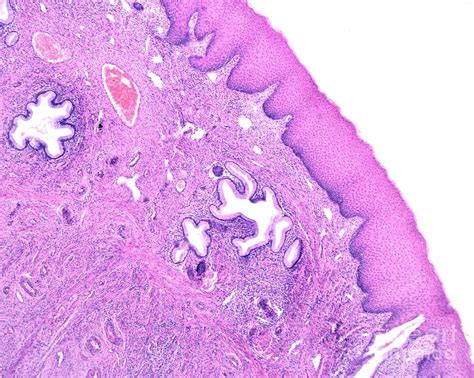 Squamous Metaplasia Of Endocervix Photograph By Jose Calvo Science Photo Library Pixels