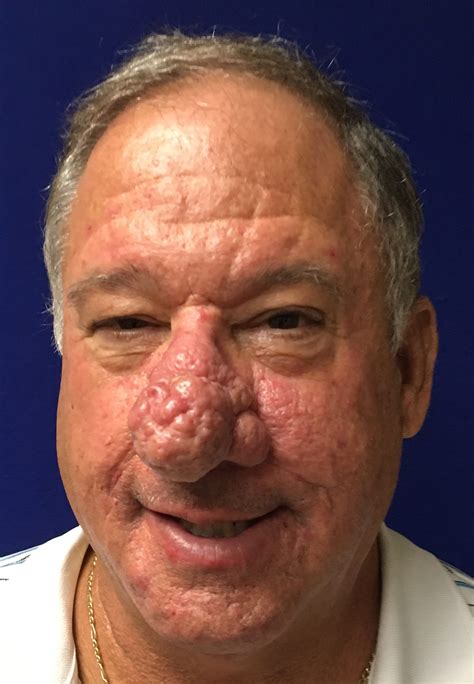 Pre And Post Rhinophyma Contouring Midwest Sinus And Allergy