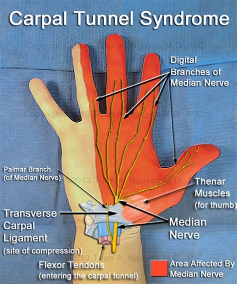 The operation takes around 20 minutes and you do not have to stay in hospital overnight. About Carpal Tunnel Syndrome - Lake Oswego Hand Surgery ...