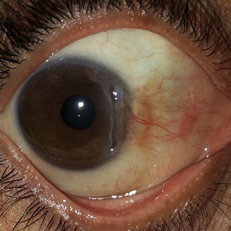 Peripheral Corneal Ulceration American Academy Of Ophthalmology