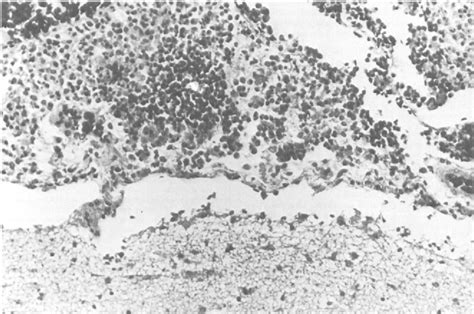 Figure 1 From Bacillus Anthracis Meningitis Semantic Scholar