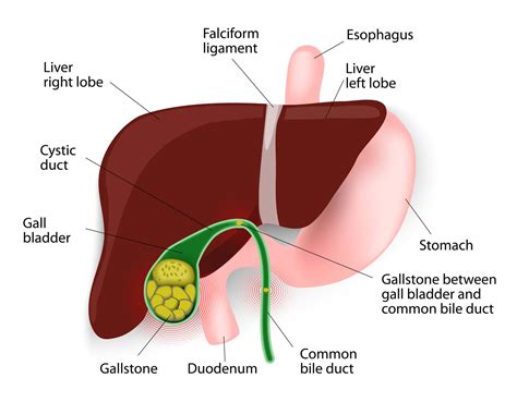 Gallstones Treatments Symptoms And Causes