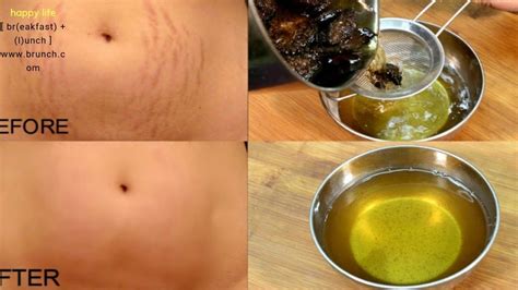 This Is The Best Way To Permanently Remove Stretch Marks Youtube