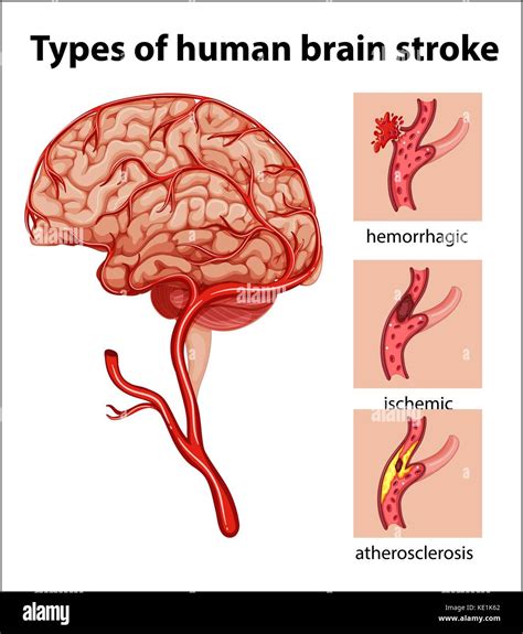 Human Brain After Stroke