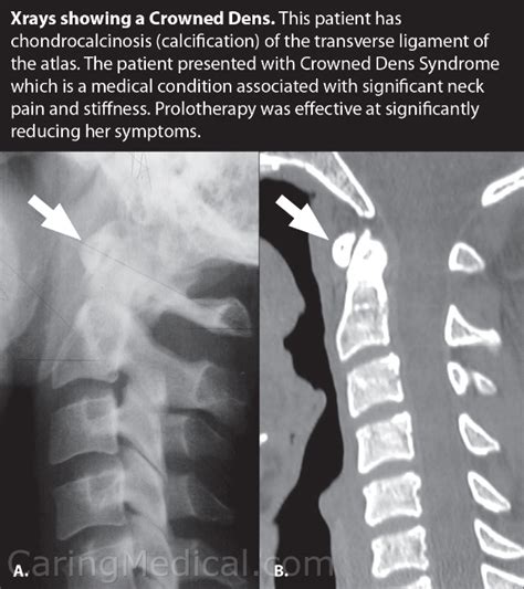 Neurologic Like Symptoms And Conditions Of Cervical Spine Instability