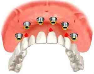 Which Dental Insurance Covers Implants Dental News Network