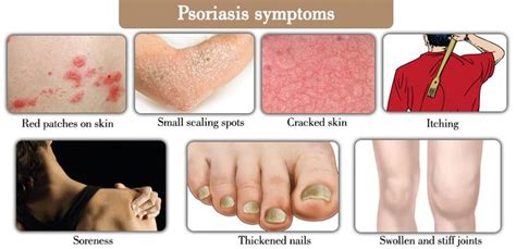 Image Result For Plaque Psoriasis Psoriasis Symptoms Psoriasis Skin
