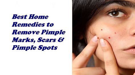 Best Home Remedies To Remove Pimple Marks Scars And Pimple Spots Youtube