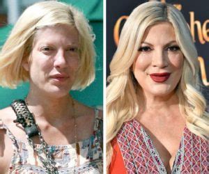 Tori Spelling Before And After Plastic Surgery