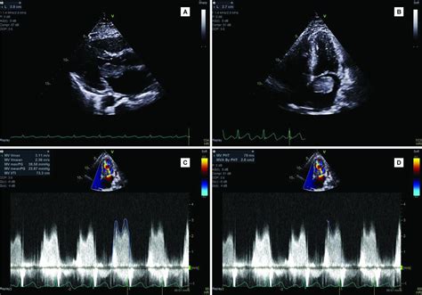 Severe Functional Mitral Stenosis Due To A Left Atrial Myxoma