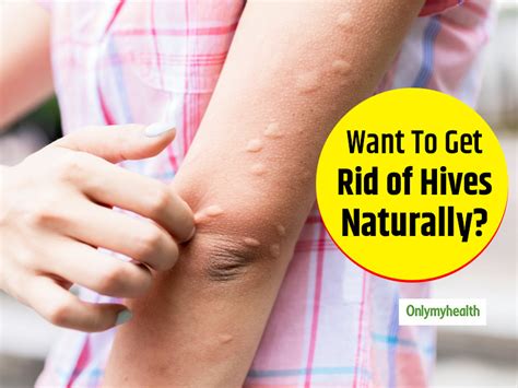 Irritated With Hives Try These Effective Natural Remedies Onlymyhealth