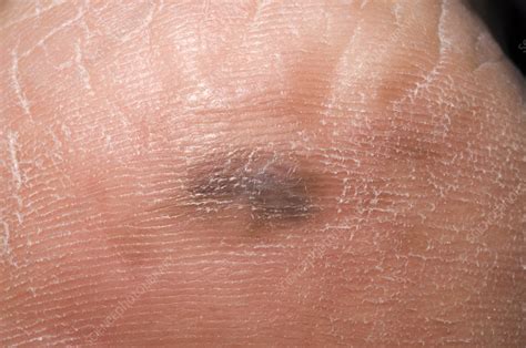 Foot pain is a very common problem. Malignant melanoma - Stock Image - M131/0676 - Science ...
