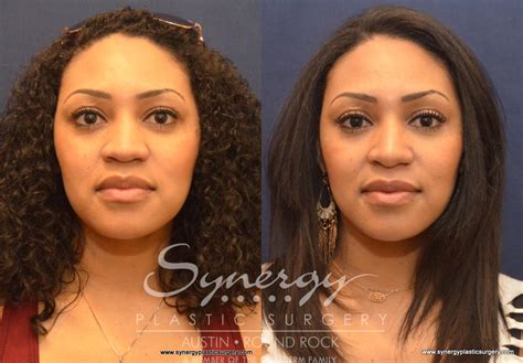 Rhinoplasty Before And After Pictures Case 603 Austin Tx Synergy