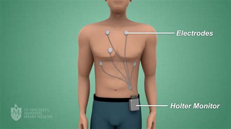 Holter Monitor St Vincents Heart Health