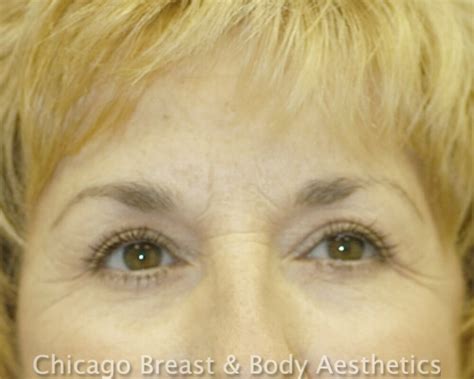 Eyelid Surgery Blepharoplasty Chicago Breast And Body Aesthetics